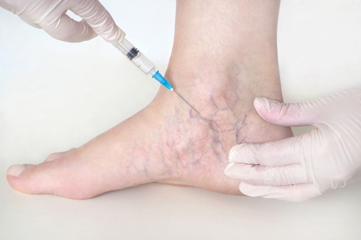 Sclerotherapy Cost For Spider Veins On The Legs in Arizona Vein Envy™